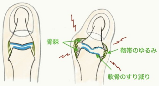 ヘバーデン結節説明図