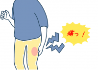 大腿部のやけどのような痛みは「感覚異常性大腿神経痛」その原因にショック