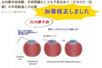 白内障手術レポート|医者は教えてくれない、そこんところ。